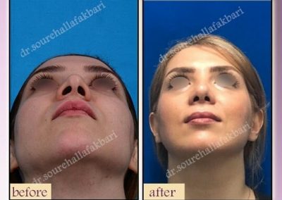 عکس قبل و بعد از عمل بینی در یک خانم جوان