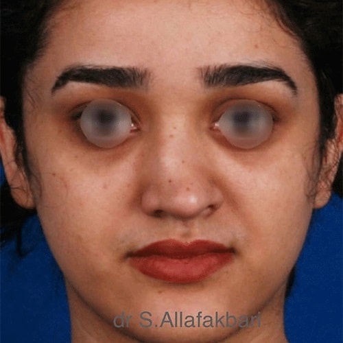 نمونه قبل از جراحی انحراف تیغه بینی توسط دکتر علاف اکبری