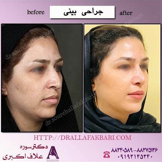 قبل و بعد از عمل زیبایی بینی - دکتر سوره علاف اکبری