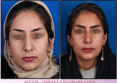 جراحی بینی استخوانی دکتر سوره علاف اکبری