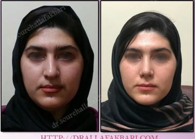 عکس قبل و بعد از عمل بینی در خانم جوان