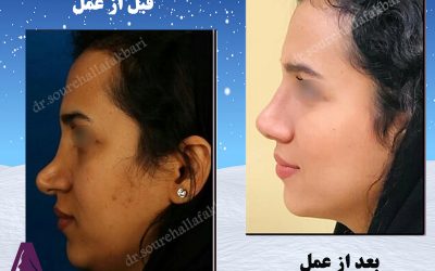 عمل زیبایی بینی در فصول سرد سال
