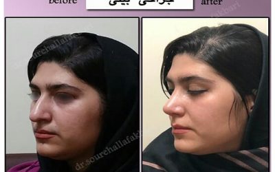 جراحی بینی طبیعی و نتایج آن