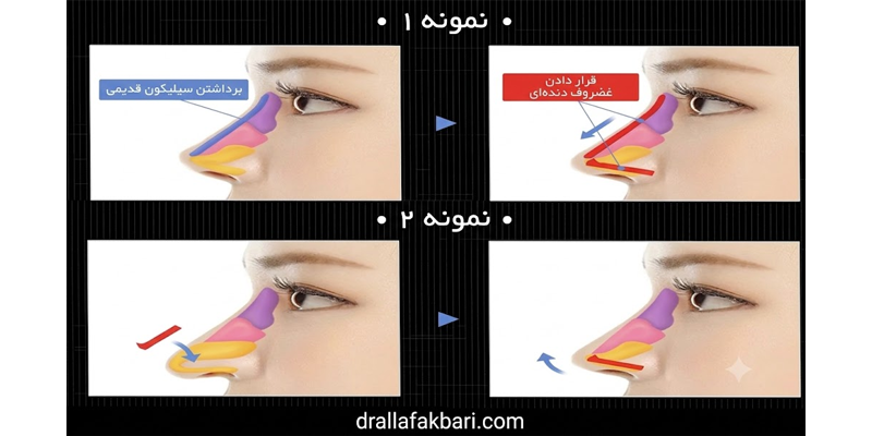 غضروف دنده برای بینی