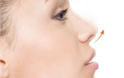 جراحی نوک بینی یا تیپ پلاستی