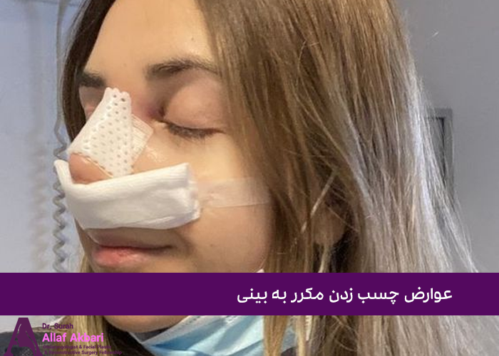 عوارض چسب زدن مکرر به بینی