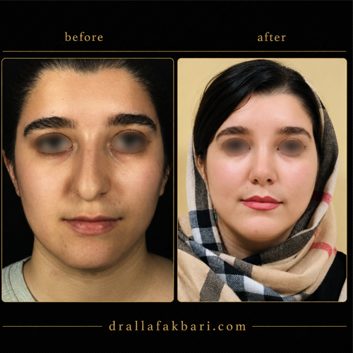 جراحی بینی نچرال