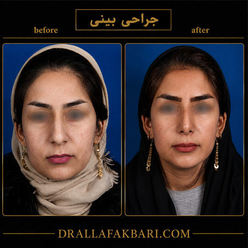 عمل بینی استخوانی دکتر سوره علاف اکبری