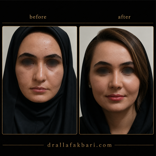 مدل بینی طبیعی عمل شده