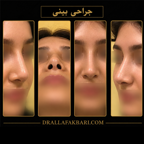 یک ماه بعد از عمل بینی
