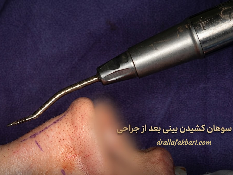 سوهان کشیدن بینی بعد از جراحی