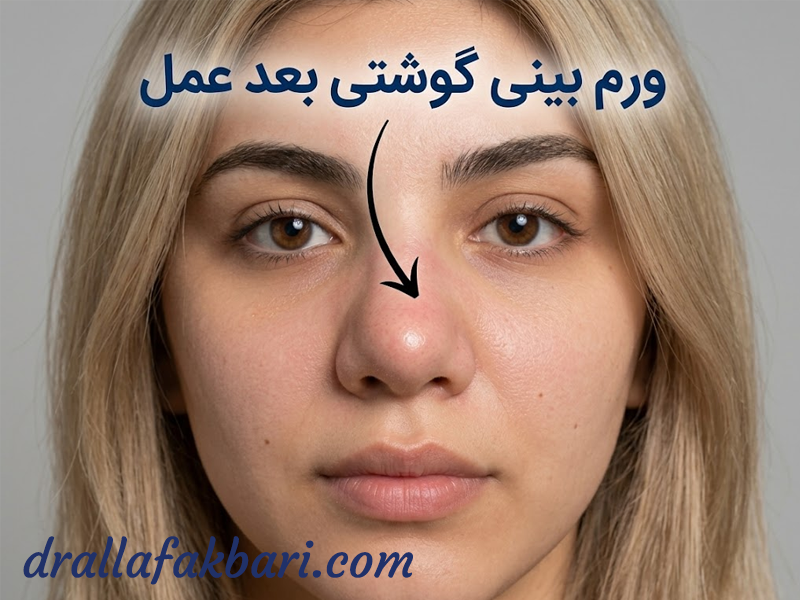 ورم بینی گوشتی