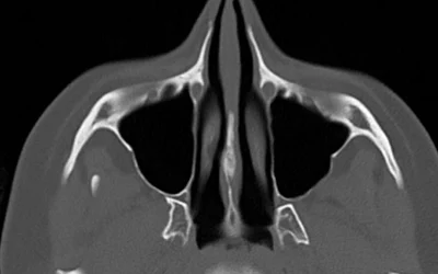 سی تی اسکن بینی چگونه است؟ راهنمای کامل، مراحل انجام و رازهای ناگفته